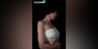 Московские врачи спасли девушку, на которой сгорело платье - M24.Ru