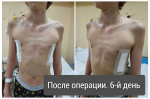 Теперь доступны операции по устранению врождённых деформаций грудной клетки
