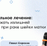 Рак шейки матки: когда «перестраховаться» лучевой терапией может быть лишним? - ФГАУ ЛРЦ